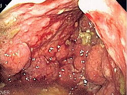Exame de endoscopia gástrica